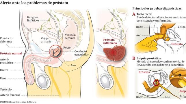 pruebas de diagnóstico sobre el cáncer de próstata, como opko 4k pruebas de diagnóstico sobre el cáncer de próstata, como opko 4k